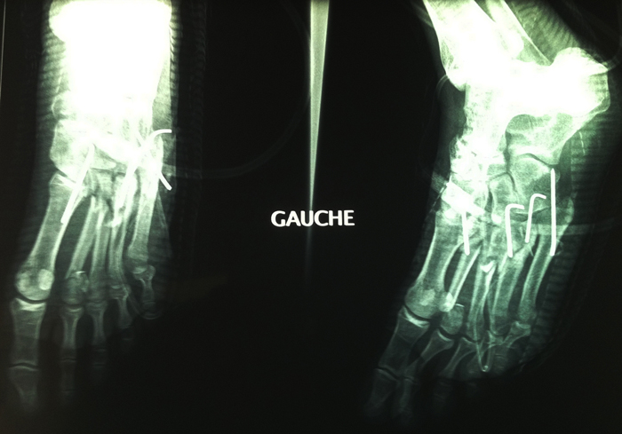 fracture-luxation_columno-spatulaire_divergente_20121217_2024321995