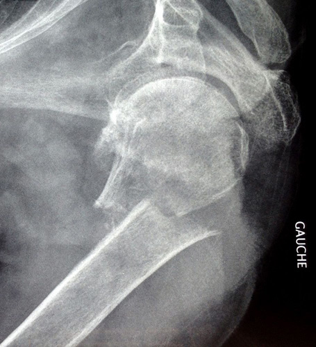fracture_col_humeral_clou_t2_20150702_1107912825